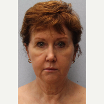 55-64 year old woman treated with Facelift, Laser resurfacing before 3615772