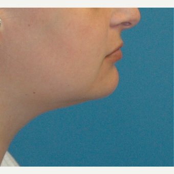 34 year old woman treated with Liposuction of the neck before 3226020