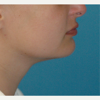 34 year old woman treated with Liposuction of the neck after 3226020