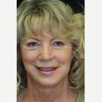 62 year old woman treated with Facelift Revision after 3629375