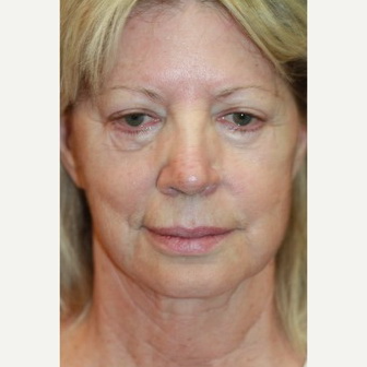 62 year old woman treated with Facelift Revision before 3629375