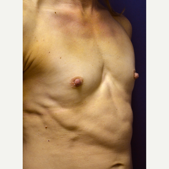 35-44 year old woman treated with Breast Augmentation before 3360955