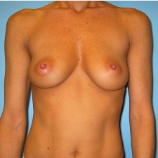 Breast Augmentation before 3665677