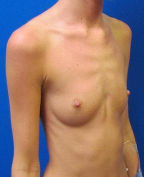 Breast Augmentation before 968184