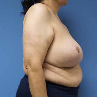 65-74 year old woman treated with Breast Reduction after 3087422