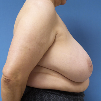 65-74 year old woman treated with Breast Reduction before 3087422