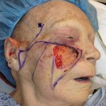 Mohs Surgery before 3711251