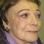 Mohs Surgery after 3711251
