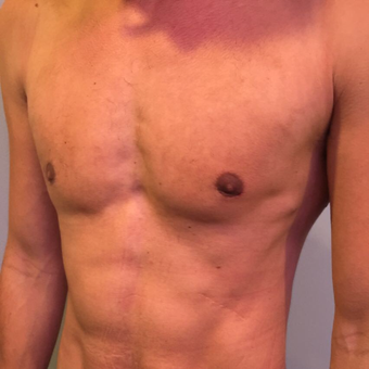 25-34 year old man treated with Male Breast Reduction after 3782510