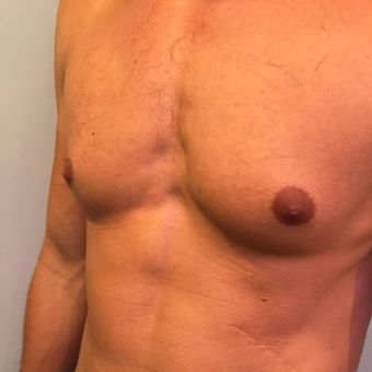 25-34 year old man treated with Male Breast Reduction before 3782510
