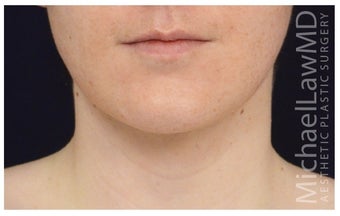 Facial Rejuvenation after 1286756