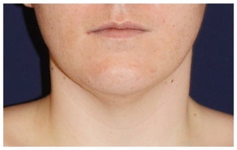 Facial Rejuvenation before 1286756