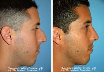 Rhinoplasty before 221413
