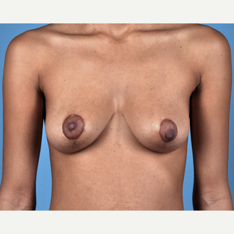 18-24 year old woman treated with Breast Lift after 3837682