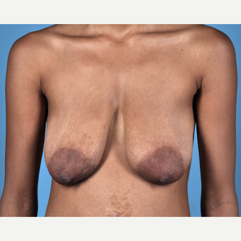 18-24 year old woman treated with Breast Lift before 3837682