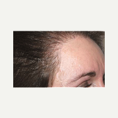 45-54 year old woman treated with Hair Transplant after 2438352