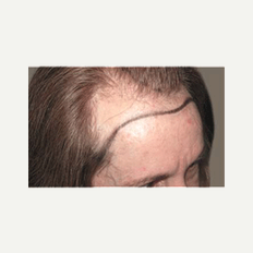 45-54 year old woman treated with Hair Transplant before 2438352