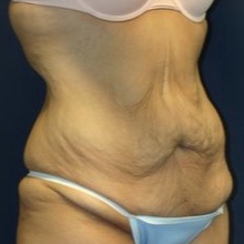 18-24 year old woman treated with Tummy Tuck before 1679391