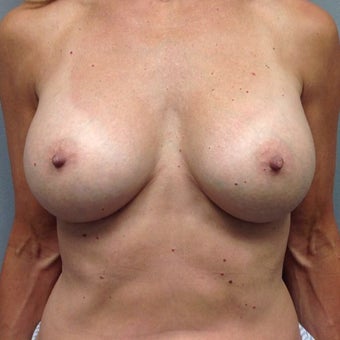 55-64 year old woman treated with Breast Augmentation after 2004554