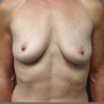 55-64 year old woman treated with Breast Augmentation before 2004554