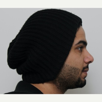 18-24 year old man treated with Revision Rhinoplasty after 3583689