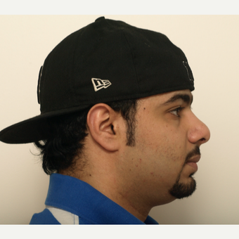 18-24 year old man treated with Revision Rhinoplasty before 3583689