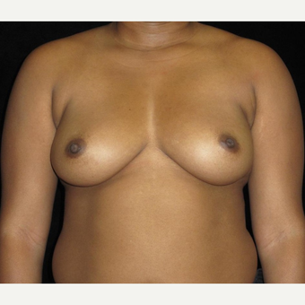 39 year old woman treated with Breast Augmentation before 3252465