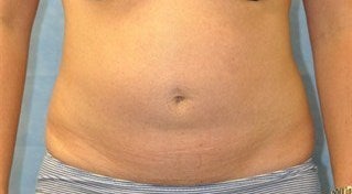 34 Year Old Female Treated for Unacceptable Cosmetic Appearance of Abdomin after 1047850