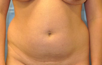 34 Year Old Female Treated for Unacceptable Cosmetic Appearance of Abdomin before 1047850