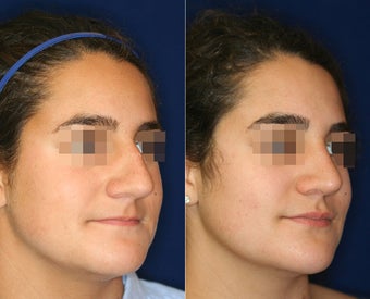 Nose Surgery before 1430591