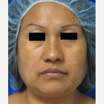 Rhinoplasty before 2993754