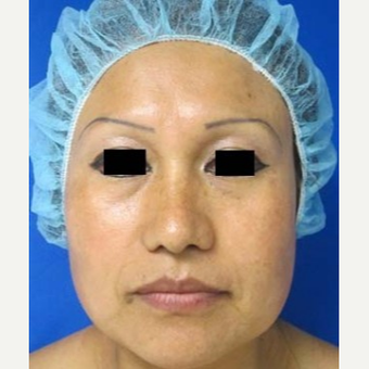 Rhinoplasty after 2993754