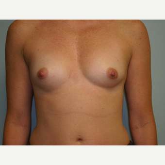Breast Augmentation before 3560732