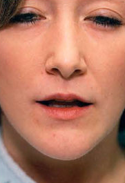 Lip Augmentation before 309540