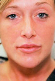 Lip Augmentation after 309540