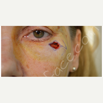 35-44 year old woman treated with Facial Reconstructive Surgery before 3505865