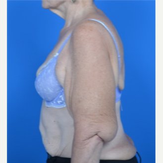 67 year old woman treated with Arm Lift before 3327814