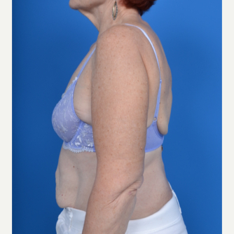 67 year old woman treated with Arm Lift after 3327814