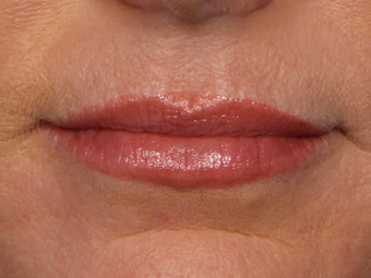Botox after 301241