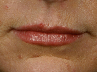 Botox before 301241