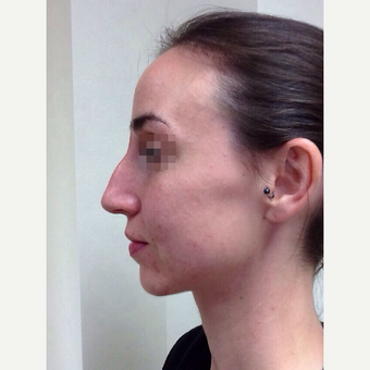 25-34 year old woman treated with Rhinoplasty before 3122809