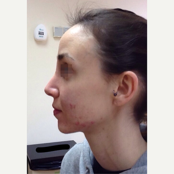 25-34 year old woman treated with Rhinoplasty after 3122809