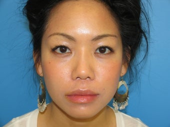 33 yr old woman using Latisse after 1071643