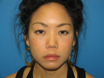 33 yr old woman using Latisse before 1071643