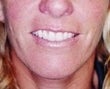 40 year old female patient before 943624