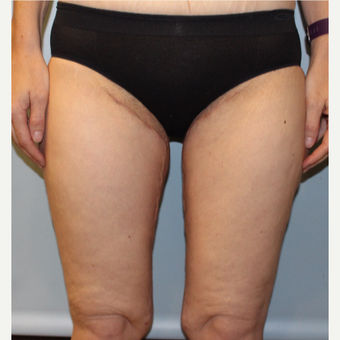 45-54 year old woman treated with Thigh Lift after 3321812