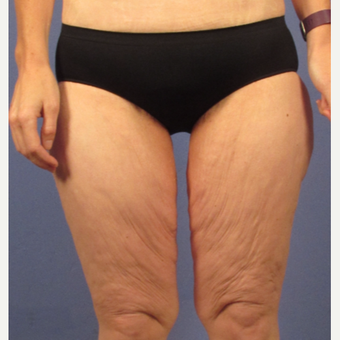 45-54 year old woman treated with Thigh Lift before 3321812