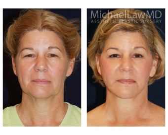 Lower Facial Rejuvenation before 1305113