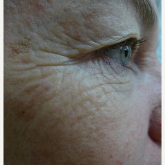 Laser Treatment before 1611903