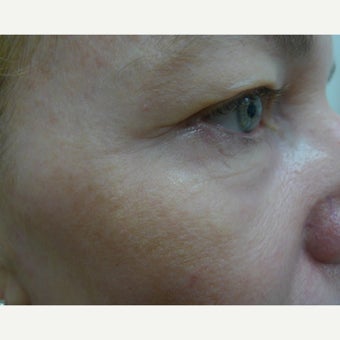 Laser Treatment after 1611903